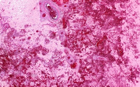 10A2 Acanthamoeba (Case10) 4XA