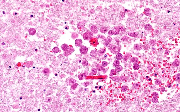 10A3 Acanthamoeba (Case10) 40X