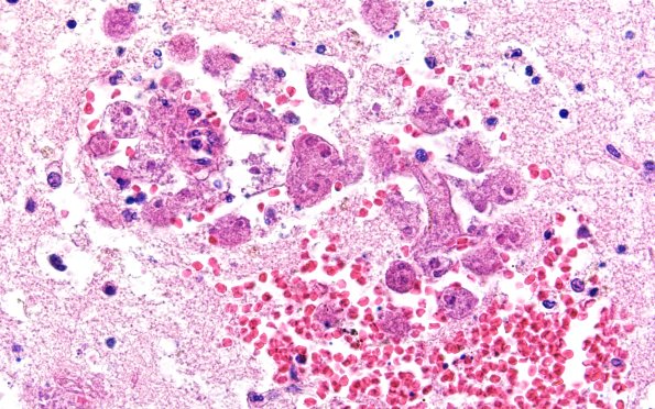 10A4 Acanthamoeba (Case10) 60X 2