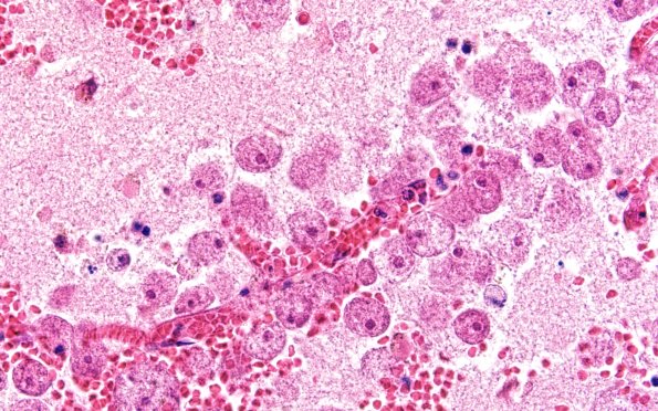 10A5 Acanthamoeba (Case10) 60X 4