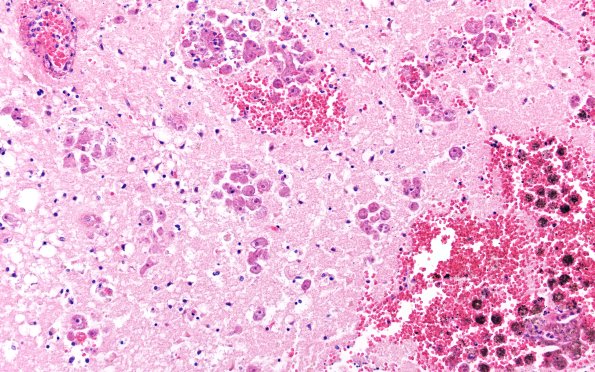 10A6 Acanthamoeba (Case10) 20X 3