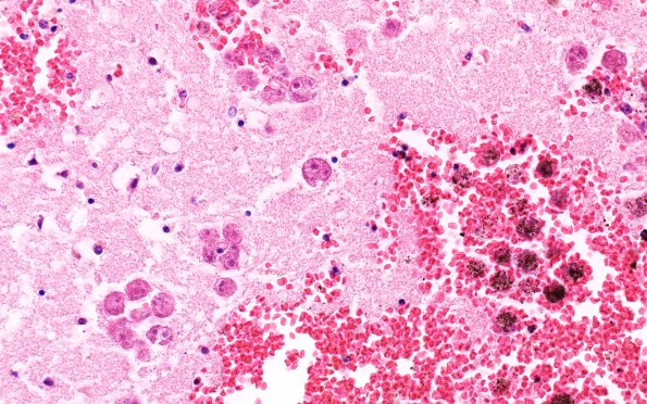 10A7 Acanthamoeba (Case10) 40X 3