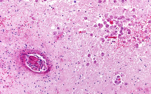 10A9 Acanthamoeba (Case10) 20X