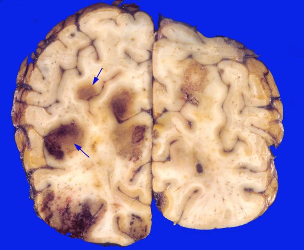 1A3 Acanthamoeba (Case 1) & AIDS 3A