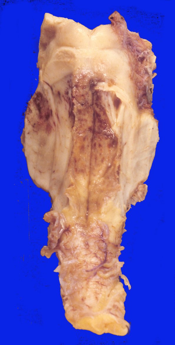 1A4 Acanthamoeba (Case 1) & AIDS 2