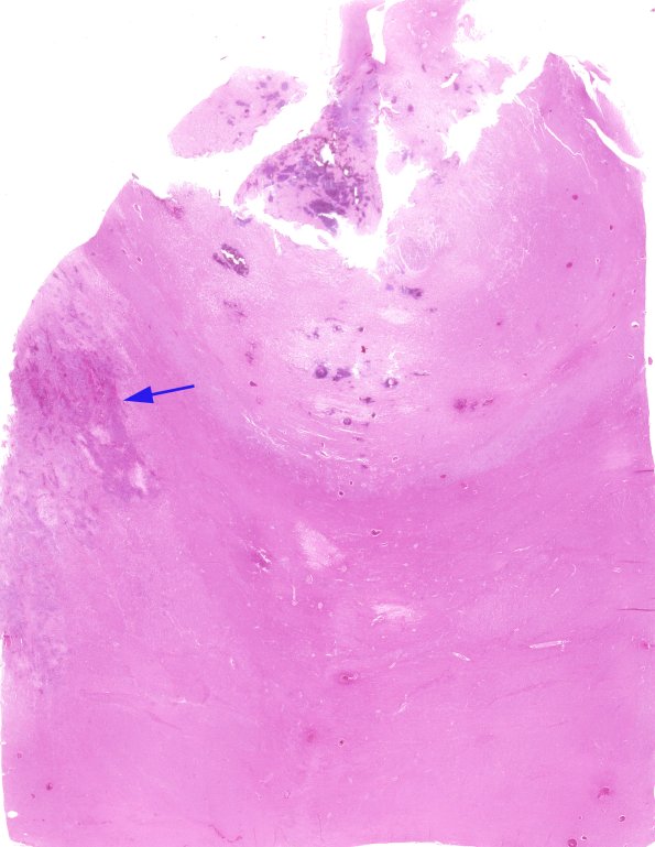 1B1 Acanthamoeba (Case 1) & AIDS 5 B