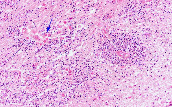 1B2 Acanthamoeba (Case 1) & AIDS H&E 20X