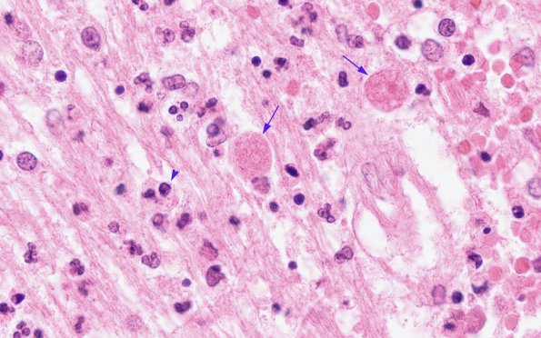 1B3 Acanthamoeba (Case 1) & AIDS H&E 100X 3B