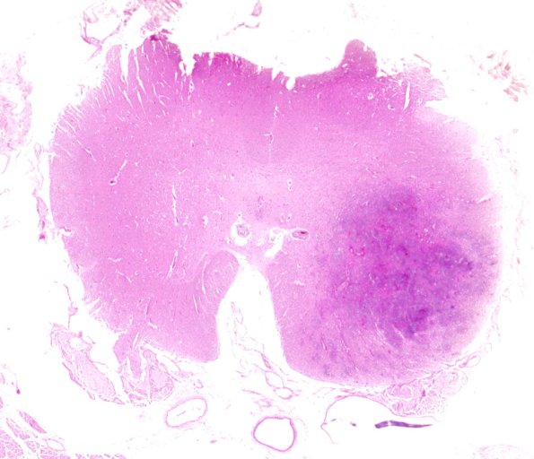 1B7 Acanthamoeba (Case 1) & AIDS Spinal cord 3