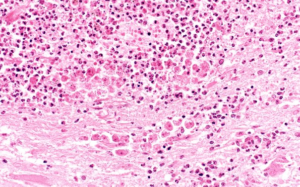 1B8 Acanthamoeba (Case 1) & AIDS Spinal cord 2A