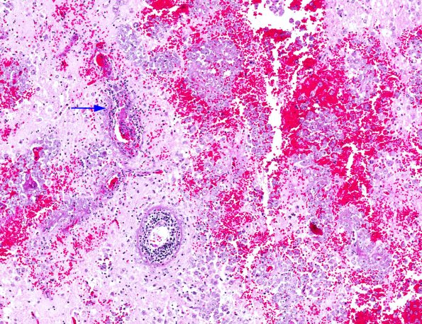 2A3 Ameba (Acanthoamoeba AANP 1984, Case 2) H&E X10 2A