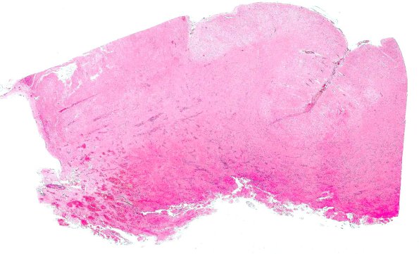 3A1 Amoeba, Meningoencephalitis (Acanthamoeba AANP 1979, Case 4) H&E X0.5