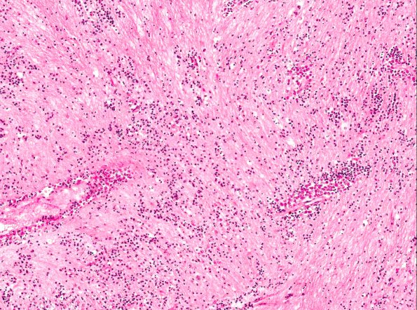 3A2 Amoeba, Meningoencephalitis (Acanthamoeba AANP 1979, Case 4) H&E X10 1