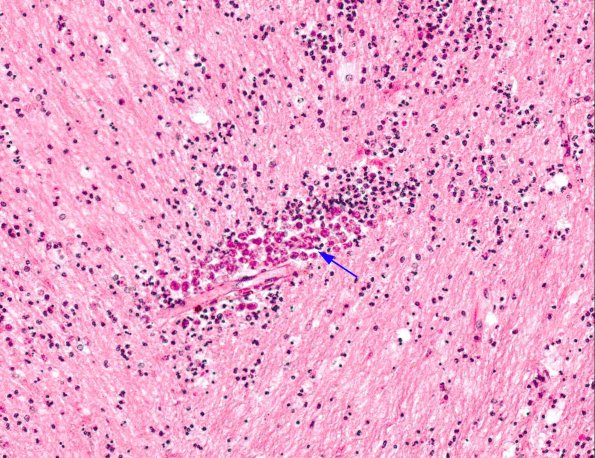 3A3 Amoeba, Meningoencephalitis (Acanthamoeba AANP 1979, Case 4) H&E X20 2