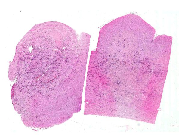 4A1 Amoebic Meningoencephalitis (Balmuthia sp, AANP 1998, Case 6) X0.5 A