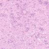 4A2 Amoebic Meningoencephalitis (Balmuthia sp, AANP 1998, Case 6) X104