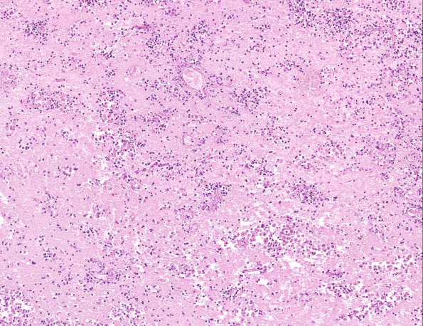 4A2 Amoebic Meningoencephalitis (Balmuthia sp, AANP 1998, Case 6) X104