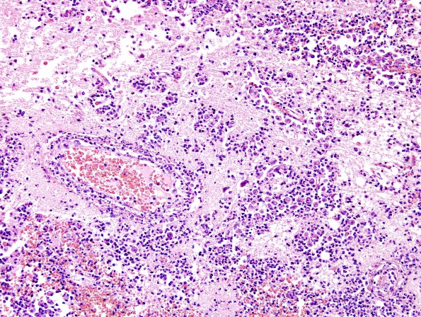 4A3 Amoebic Encephalitis (Balmuthia, AANP 1998-6) H&E H&E 6 A