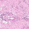 4A4 Amoebic Meningoencephalitis (Balmuthia sp, AANP 1998, Case 6) X20 1 A