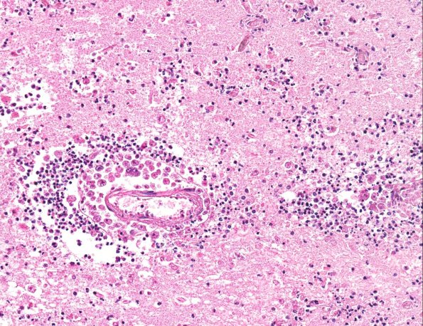 4A4 Amoebic Meningoencephalitis (Balmuthia sp, AANP 1998, Case 6) X20 1 A