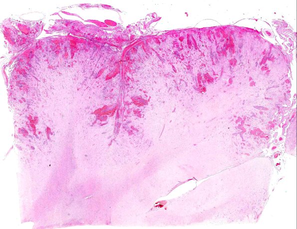 5A2 Amoebic Meningoencephalitis, Naeglaria fowleri (AANP 1968, Case 1) H&E X0.8