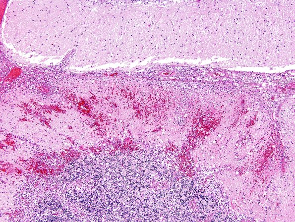 5A3 Amoeba, Nagleria fowleri (AANP 1968, Case 1) H&E 4