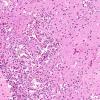 6A3 Amoebic Meningoencephalitis (Naeglaria fowleri, AANP 1992, Case 5) H&E X20 2 (2)