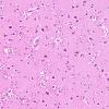 6A4 Amoebic Meningoencephalitis (Naeglaria fowleri, AANP 1992, Case 5) H&E X20 4