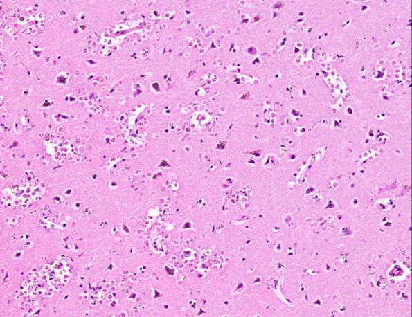 6A4 Amoebic Meningoencephalitis (Naeglaria fowleri, AANP 1992, Case 5) H&E X20 4