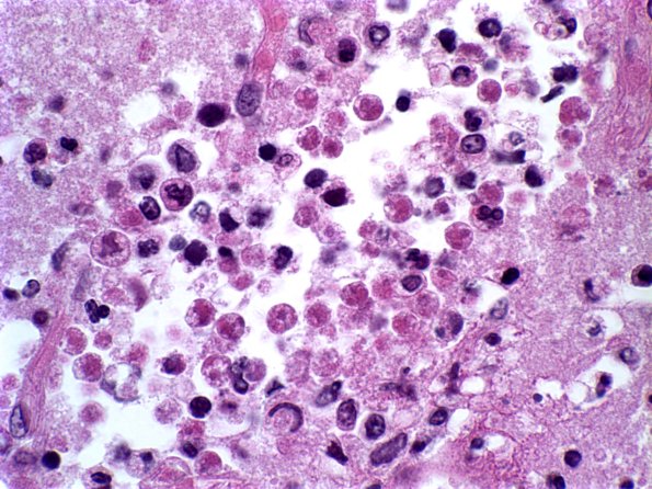 7 Amoebic Encephalitis, N Fowleri, (Case 2) H&E 2A