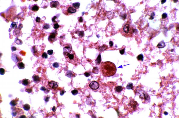 8D6 Amoeba, Entamoeba histolytica 2e (Case 3)  (Fe hematoxylin)