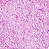 1A3 Chagas Disease (Am Trypanosomiasis, AANP 1997, Case 7) H&E X6 2