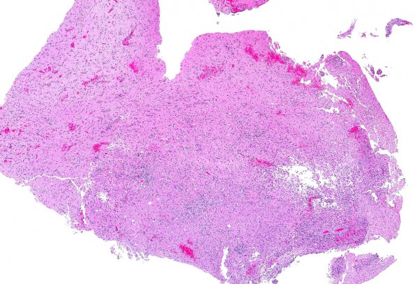 2A1 Meningoencephalitis, Chagas disease (Trypanosoma cruzi, AANP 2014 Case 6) H&E 3X