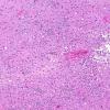 2A2 Meningoencephalitis, Chagas disease (Trypanosoma cruzi, AANP 2014 Case 6) H&E 10X