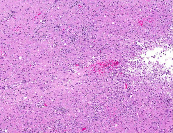 2A2 Meningoencephalitis, Chagas disease (Trypanosoma cruzi, AANP 2014 Case 6) H&E 10X