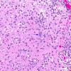 2A3 Meningoencephalitis, Chagas disease (Trypanosoma cruzi, AANP 2014 Case 6) H&E 24X