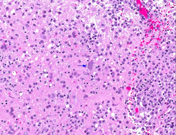 2A3 Meningoencephalitis, Chagas disease (Trypanosoma cruzi, AANP 2014 Case 6) H&E 24X