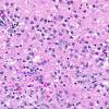 2A4 Meningoencephalitis, Chagas disease (Trypanosoma cruzi, AANP 2014 Case 6) H&E 34X