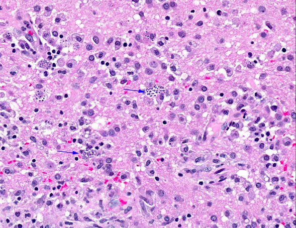 2A4 Meningoencephalitis, Chagas disease (Trypanosoma cruzi, AANP 2014 Case 6) H&E 34X