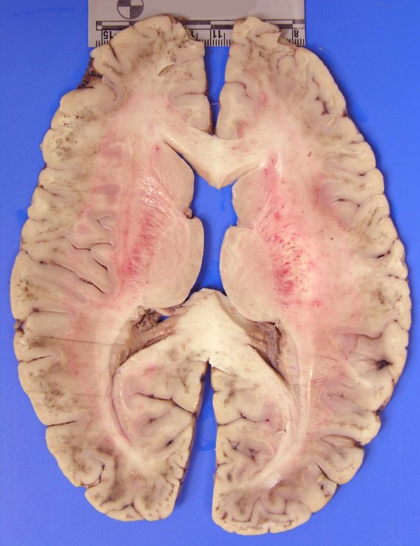 1A2 Malaria (Case 1, Alice Smith MD thanks) gross 2A