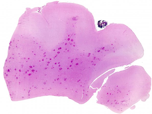 2A1 Malaria, cerebral (Case 2) H&E whole mount 2