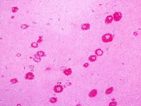 2A2 Malaria, cerebral (Case 2) H&E 1