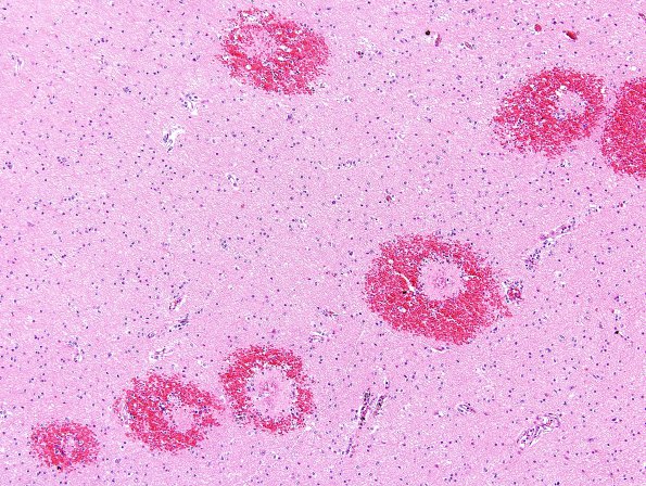 2A3 Malaria, cerebral (Case 2) H&E 2A