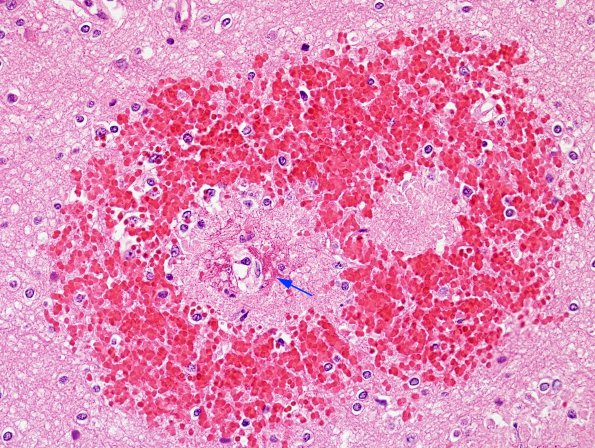 2A4 Malaria, cerebral (Case 2) H&E 3