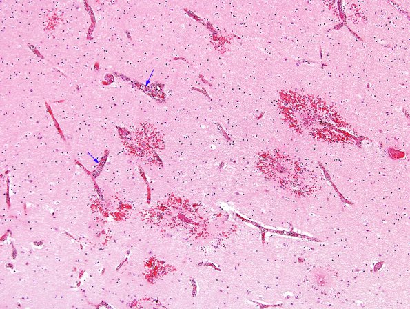 2A5 Malaria, cerebral (Case 2) H&E