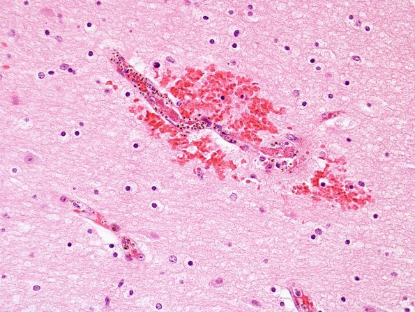 2A6 Malaria, cerebral (Case 2) H&E 1