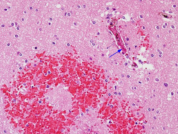 2A7 Malaria, cerebral (Case 2) H&E 5.