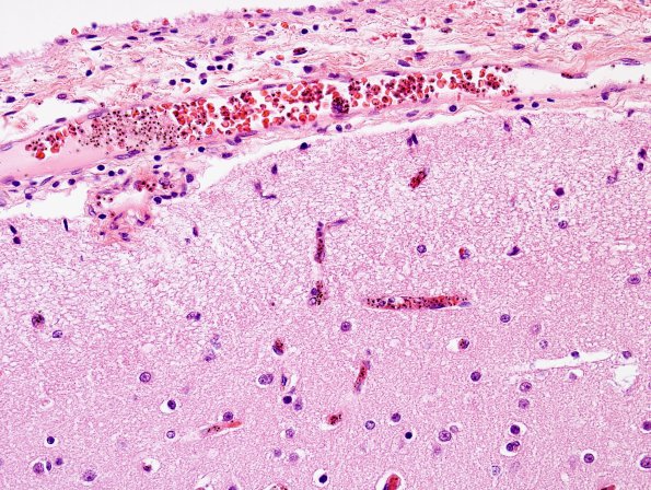 2A8 Malaria, cerebral (Case 2) H&E 3