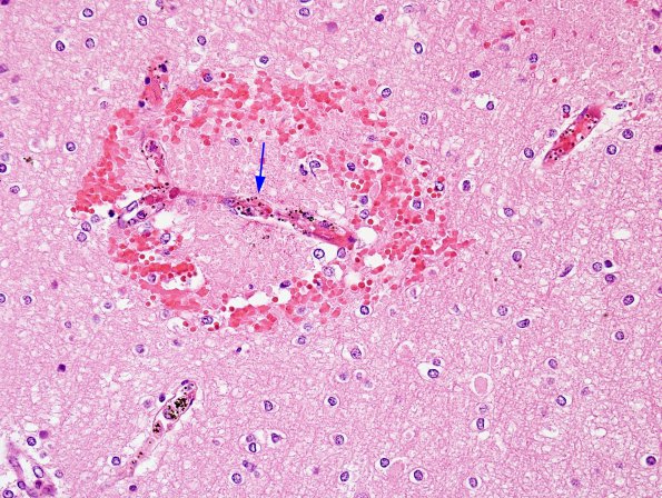 2A9 Malaria, cerebral (Case 2) H&E 6