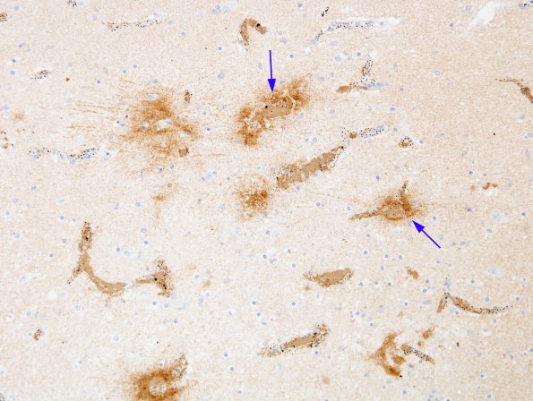 2B2 Malaria, cerebral (Case 2) Fibrinogen 1